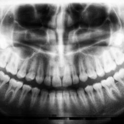 Refaire toutes ses dents en france
